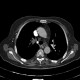 Pulmonary hypertension, obliteration of the right pulmonary artery, hypertrophy of bronchial artery, mosaic perfusion: CT - Computed tomography